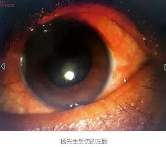 白内障和青光眼都是致盲性眼病,其中青光眼的病程不逆转。杨先生拖延伤情导致同时并发白内障、青光眼的情况,十分令人惋惜。”出名眼科专家、成都6686体育(中国)官方网站 - 登录入口陈晓明教授表示2.jpg 白内障和青光眼都是致盲性眼病,其中青光眼的病程不逆转。杨先生拖延伤情导致同时并发白内障、青光眼的情况,十分令人惋惜。”出名眼科专家、成都6686体育(中国)官方网站 - 登录入口陈晓明教授表示2.jpg