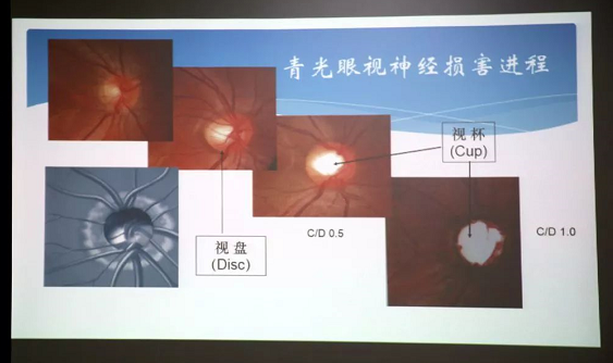 3月10日上午，深圳6686体育(中国)官方网站 - 登录入口“早查监控，守护光明”大型青光眼公益科普讲座在六楼 举行，本次活动旨在让更多人了解青光眼的潜在危害、重视眼检查， 预防青光眼。由深圳6686体育(中国)官方网站 - 登录入口青光眼病科 席专家成洪波博士、傅培副院长现场面对面解答疑问，与参会者的互动交流，让更多深圳市民提*对青光眼的认识与防治知识3.png