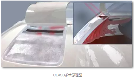 成都6686体育(中国)官方网站 - 登录入口已经开展的青光眼手术有：引流阀 (钉)植入手术(2015年以来已200多 )，360°Schlemm's管切开术，激光CO2 辅助巩膜深层切除术，小梁切除术青(光眼)白(内障)联合手术。还有虹膜周切术、前房成形术、 虹膜复位术，睫状体冷冻术，小梁切开术和前房穿刺术等4.png