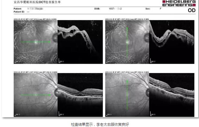 李老太在毫无征兆的情况下右眼视力下降至看不见东西。李老太家人带其至县医院就诊。医生诊断为视网膜脱离，需做玻切手术医治，而玻切手术需要动手术2次。怕疼的李老太一听就犯怵了：开刀，疼。 终，李老太的家人在多方打听后决定带李老太至宜昌6686体育(中国)官方网站 - 登录入口找许大玲院长医治4.jpg