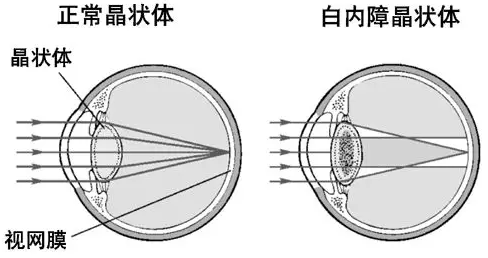 白内障应早做复明手术1.png