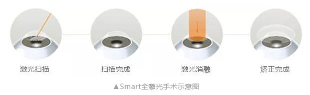 主流近视手术包含全飞秒激光手术、Smart全激光手术、半飞秒激光手术、晶体植入手术2.jpg 主流近视手术包含全飞秒激光手术、Smart全激光手术、半飞秒激光手术、晶体植入手术2.jpg