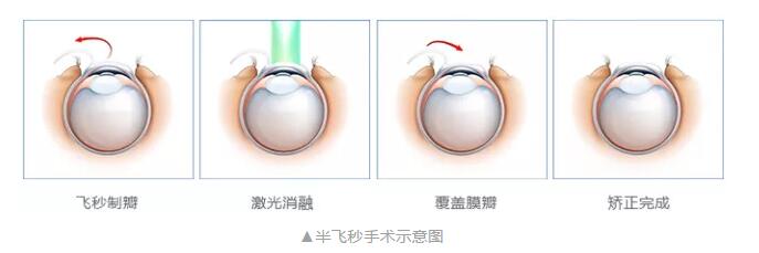主流近视手术包含全飞秒激光手术、Smart全激光手术、半飞秒激光手术、晶体植入手术3.jpg 主流近视手术包含全飞秒激光手术、Smart全激光手术、半飞秒激光手术、晶体植入手术3.jpg